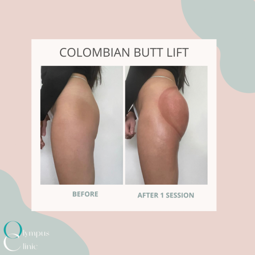 COLOMBIAN BUTT LIFT – Olympus Clinic